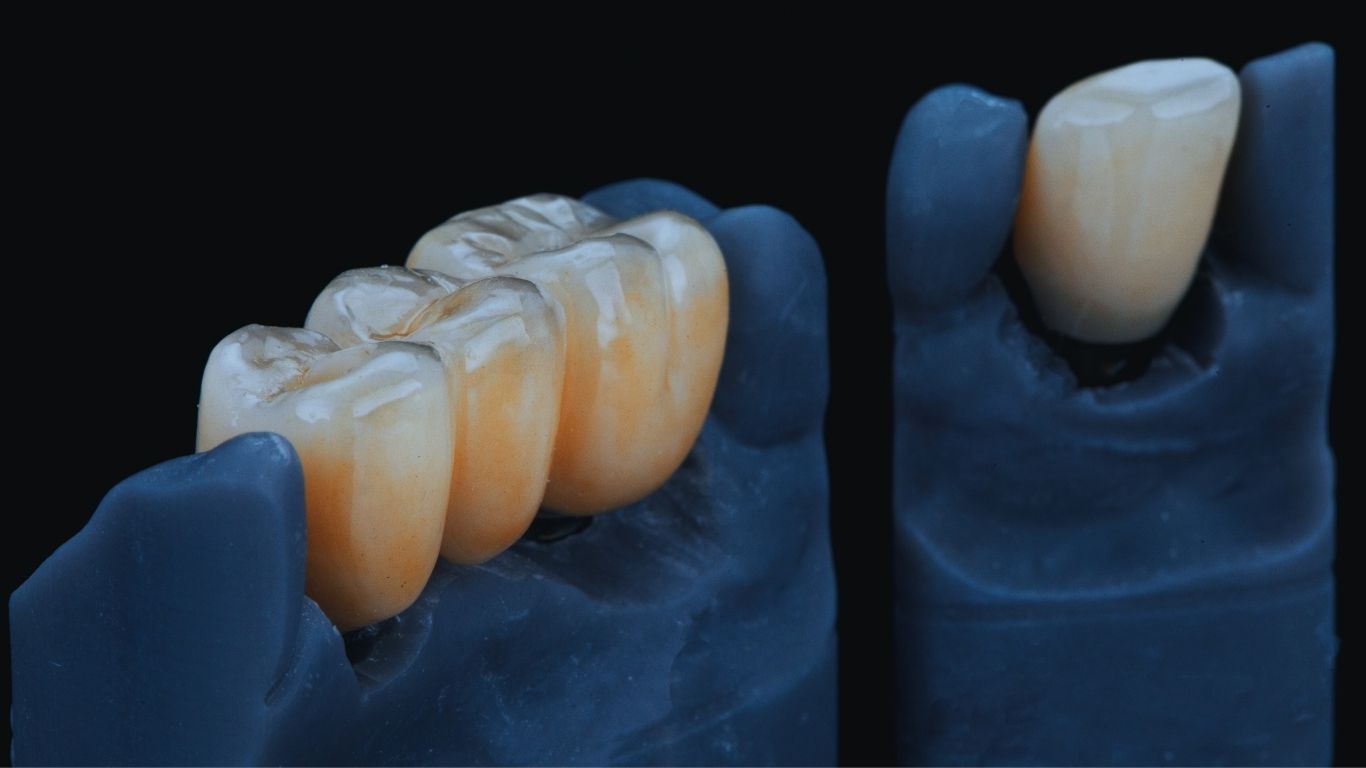 Zirconio en Odontología: Todo lo que Debes Saber