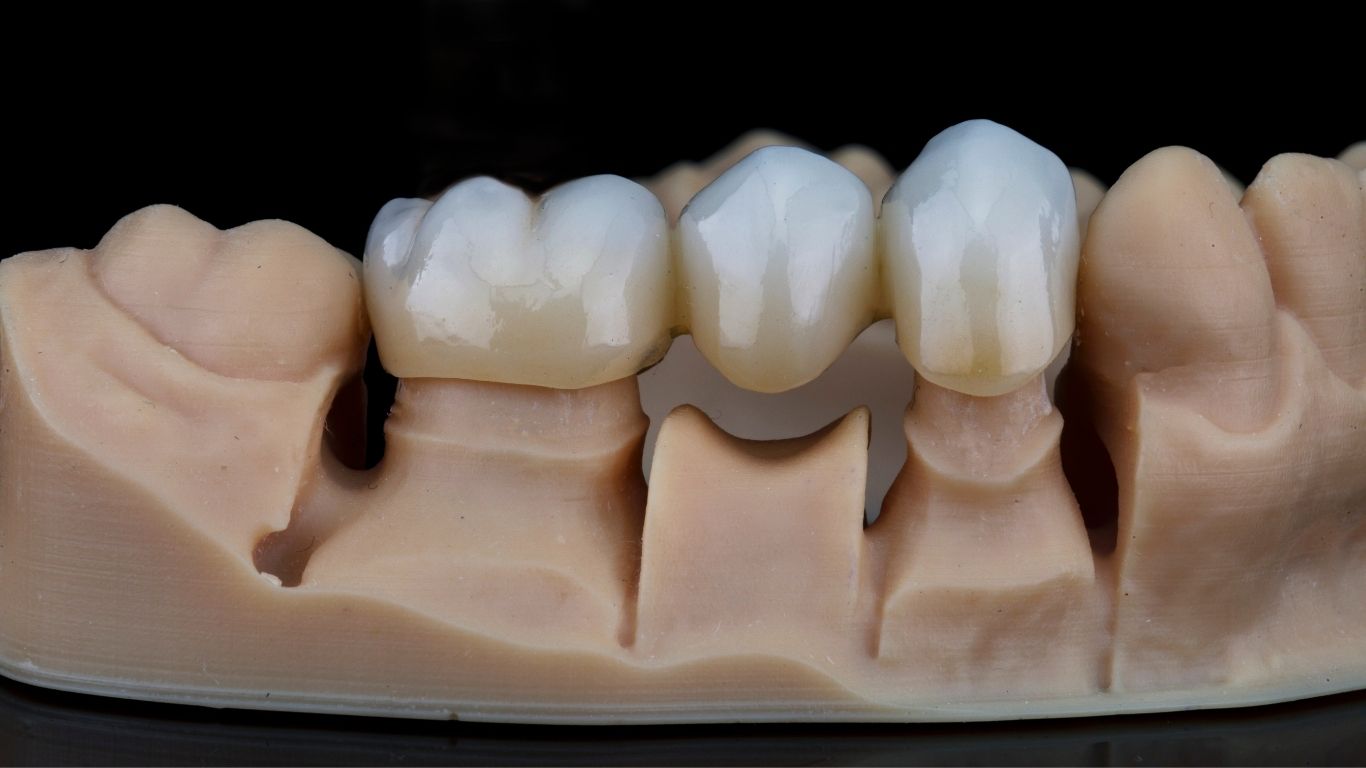 Diferencias entre Zirconio y Metal-Cerámica en Prótesis Dentales