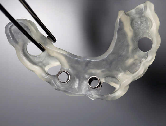 Férulas Quirúrgicas en Implantología: Precisión y Seguridad en Cada Tratamiento